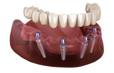 All-on-4 Full Mouth Dental Implants