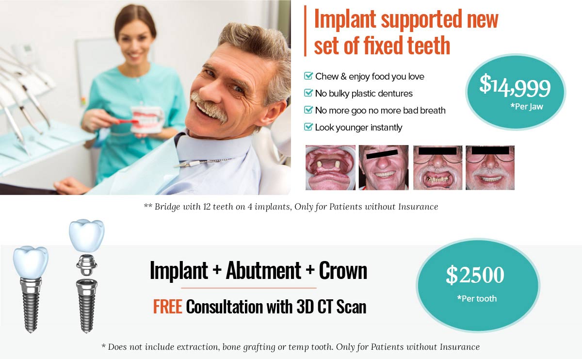Implant supported new set of fixed teeth offer near San Carlos CA