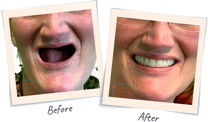 Dental Smile Tranformation - Before & After Dental images San Carlos CA