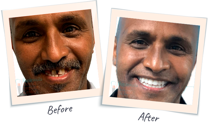 Dental Smile Tranformation - Before & After Dental images San Carlos CA