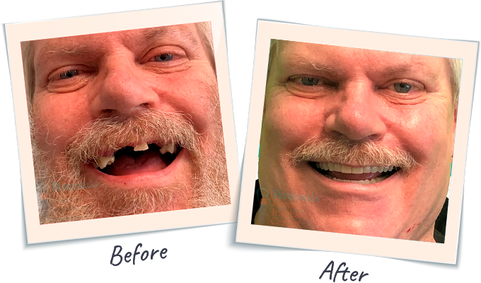 Dental Smile Tranformation - Before & After Dental images San Carlos CA