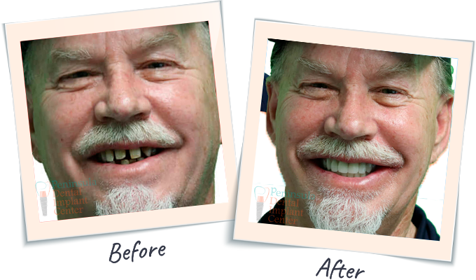 Dental Smile Tranformation - Before & After Dental images San Carlos CA