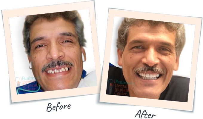 Dental Smile Tranformation - Before & After Dental images San Carlos CA