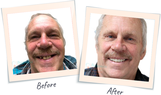 Dental Smile Tranformation - Before & After Dental images San Carlos CA