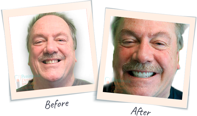 Dental Smile Tranformation - Before & After Dental images San Carlos CA