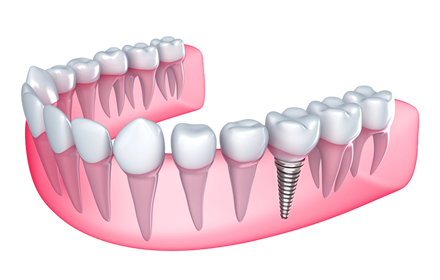 Single Tooth Implant