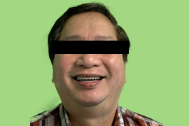 Before & After happy Patient Smile at Peninsula Dental Implant Center San Carlos