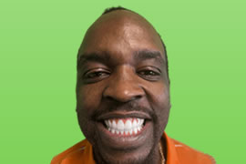 Case 109 - Real patient dental results of Peninsula Dental Implant Center