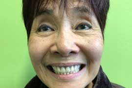 Smile Tranformation 17