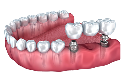 Three Teeth Implant
