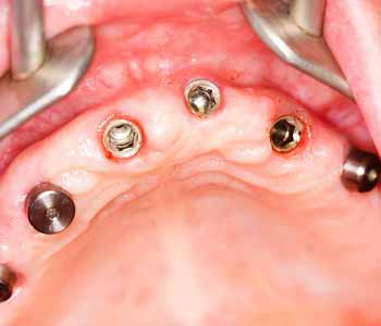 Dental implants may require a sinus lift