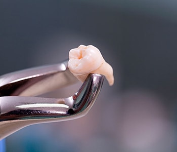 Teeth Extraction Procedure Palo Alto CA