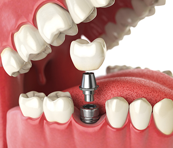 Affordable Dental Implant San Carlos