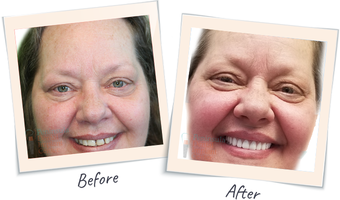 Dental implants before after results near Burlingame area image 2