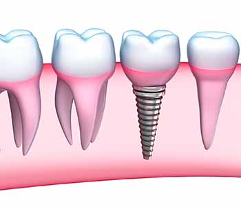Burlingame Dental Implant Treatment