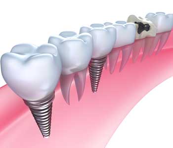 Dental Implants near Atherton CA