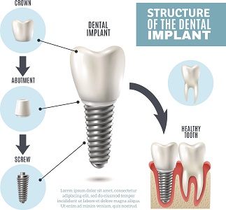 Dental Implants Redwood City CA