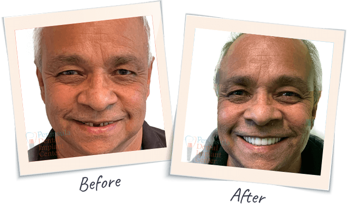 One-day dental implants before after results near San Mateo area