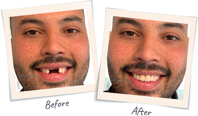 Immediate, same-day implants before & after results 1