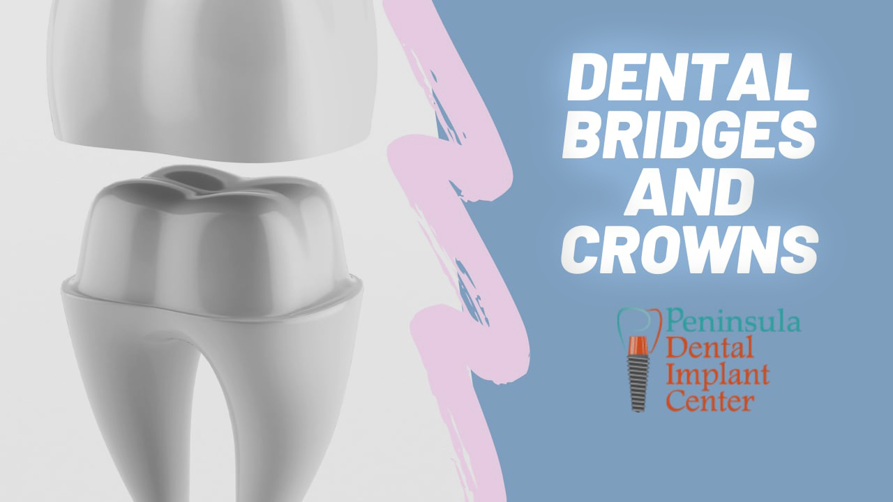 Dental Bridges and Crowns
