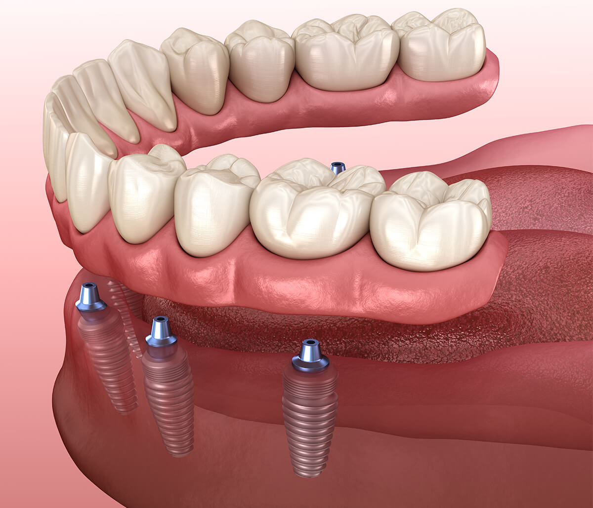 Implant-Supported Dentures in San Francisco Area