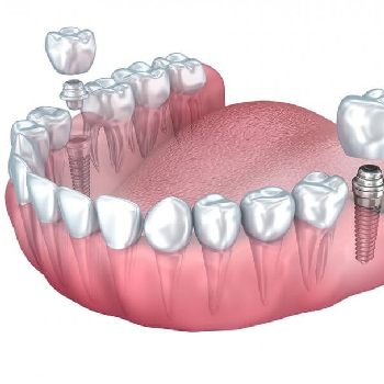  Treatments For Dental Crowns and Bridges