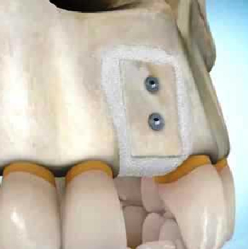 How stable is the Bone Grafting treatment