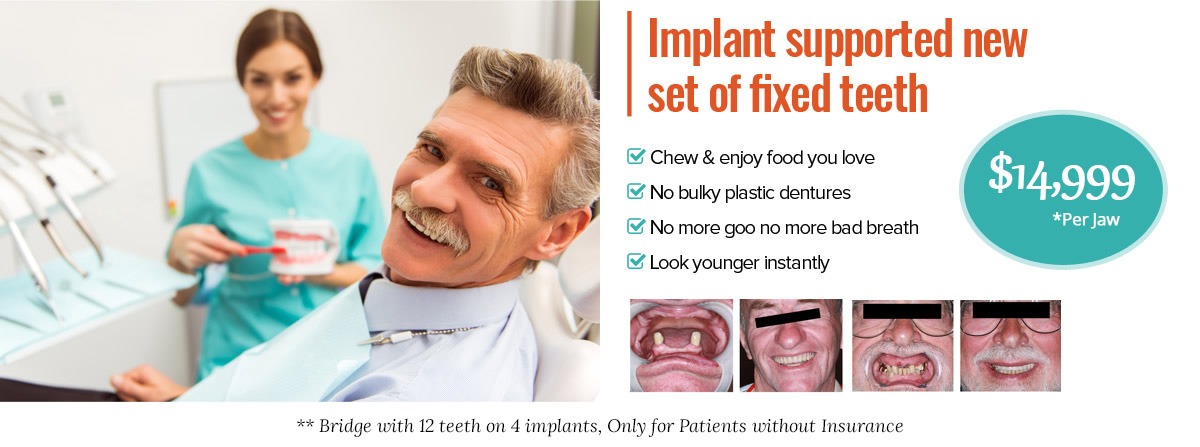 Implant supported new set of fixed teeth