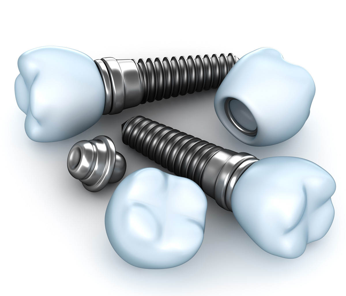 Single Tooth Dental Implant Near Me in San Francisco Area