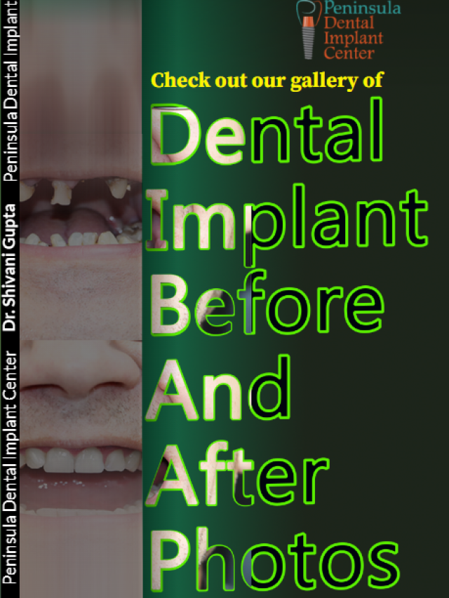 Dental implant before and after photos