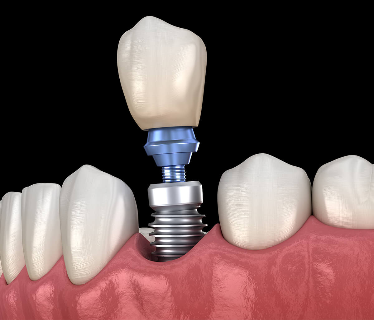 Dental Implant Recovery Time in San Carlos CA Area