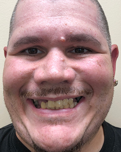 Derrek Gones - Before & After Results, Before Image-2