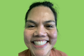 Anabel L - Real patient dental results of Peninsula Dental Implant Center