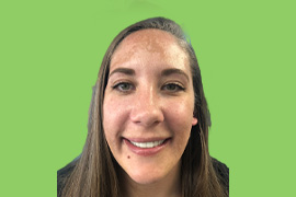 Jacquelyne M - Real patient dental results of Peninsula Dental Implant Center