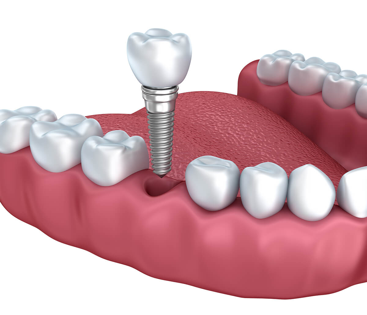 Am I a Good Candidate For Dental Implants in San Francisco CA Area