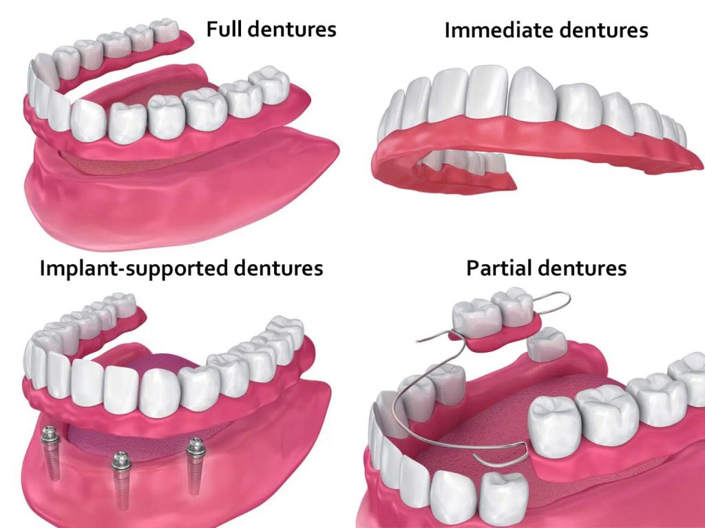 Types and Quality of Dentures Treatment in the area of San Carlos CA