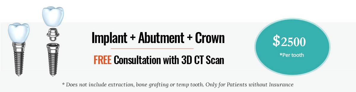 Implant, Abutment and Crown Offer