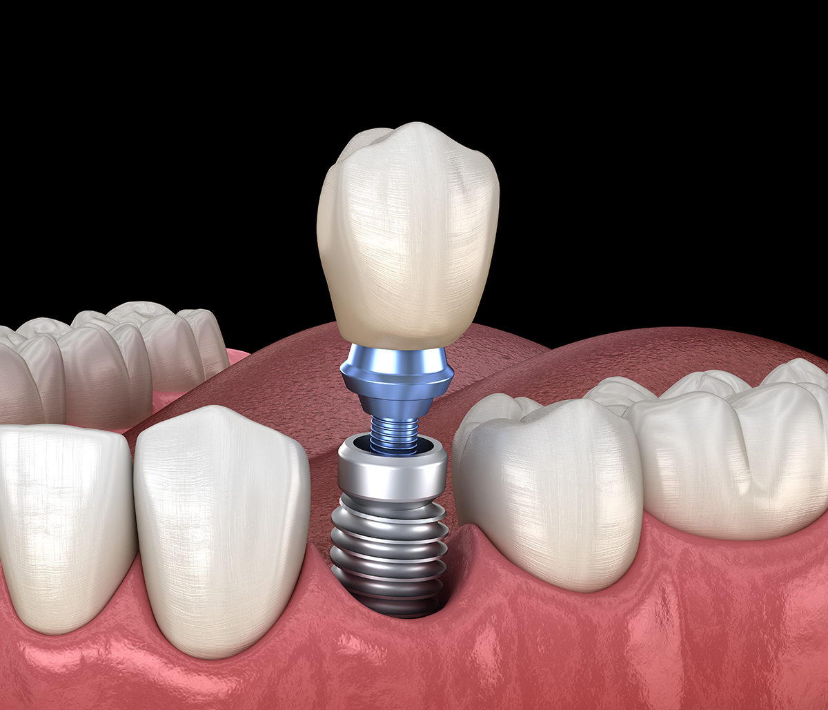 What are the benefits of metal-free ceramic dental implants in San Francisco Area
