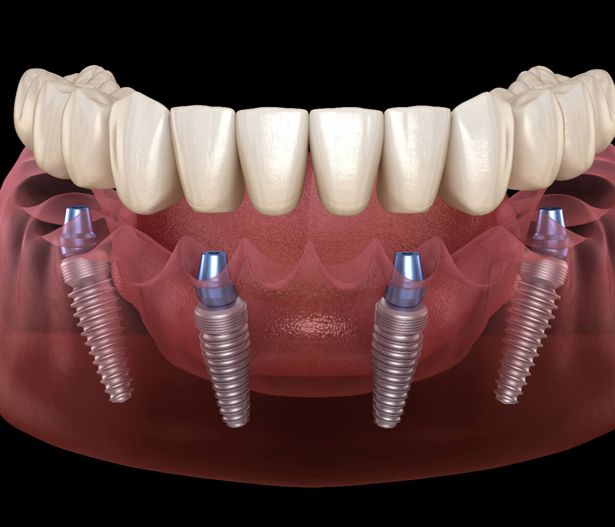 All on 4 Implant Dentures in San Francisco CA area