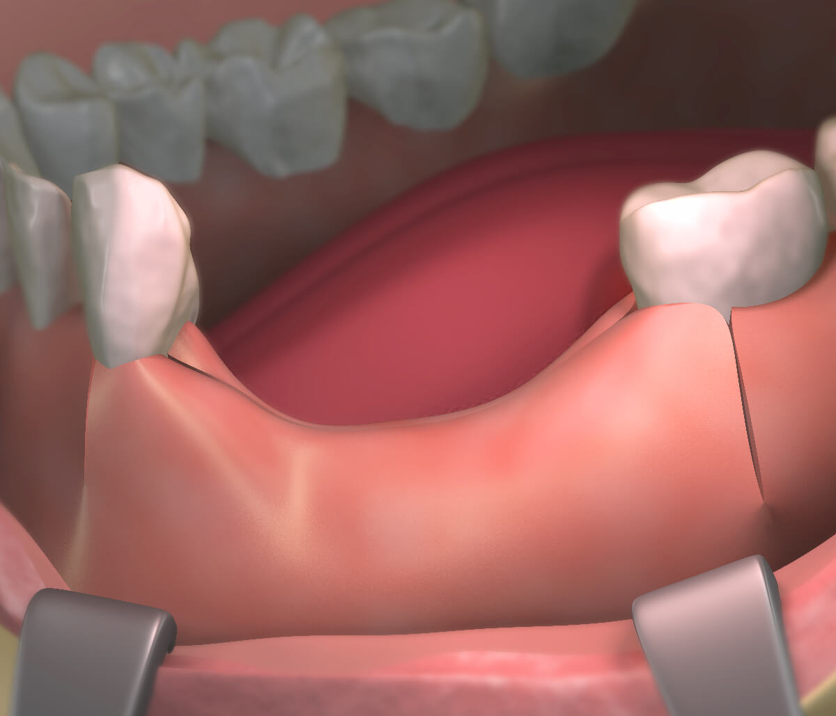 Grafting Jaw Bone for Implants in San Francisco CA area