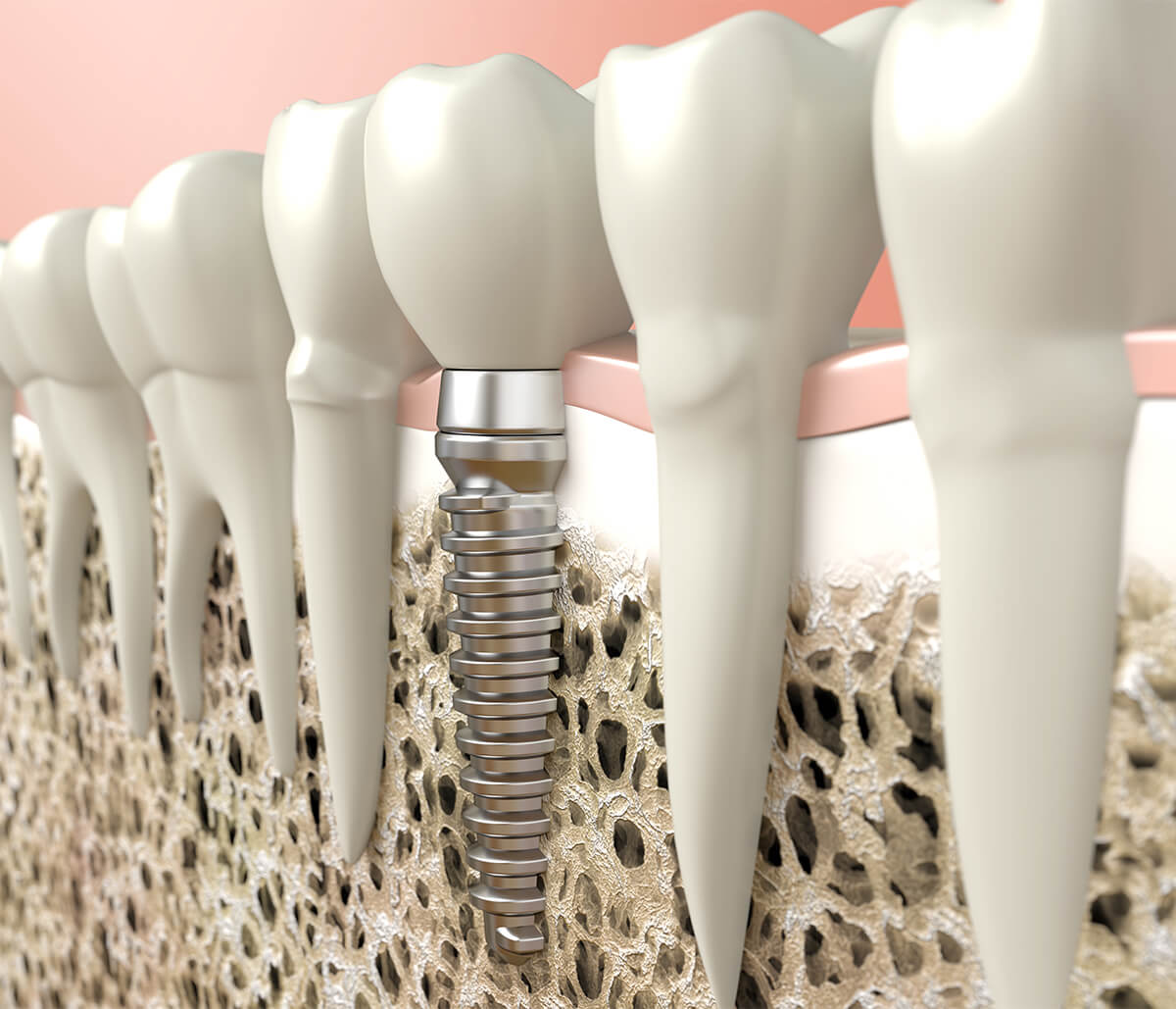 Full Mouth Dental Implants Cost in San Bruno Area
