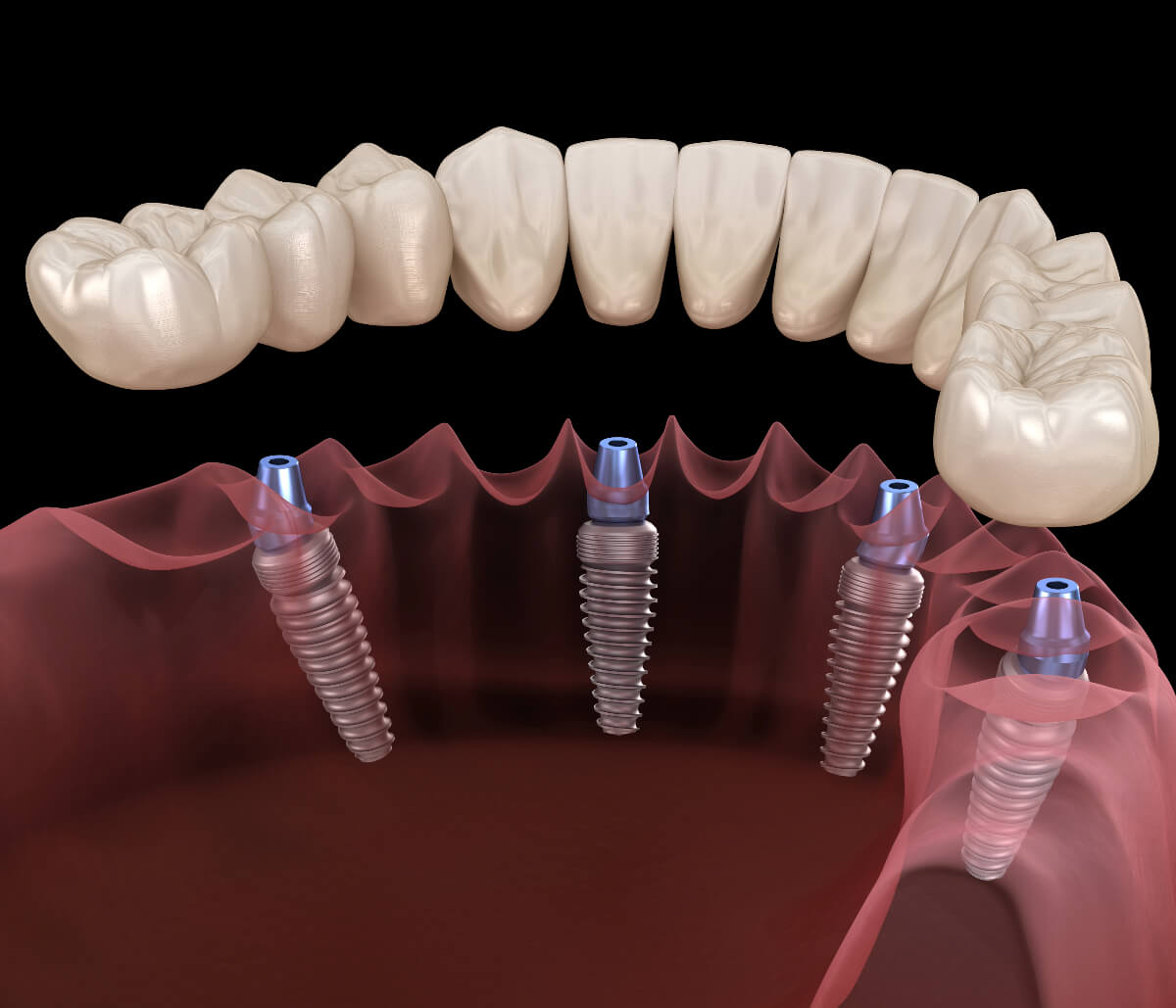 All-on-4 Dental Implants in San Mateo CA area