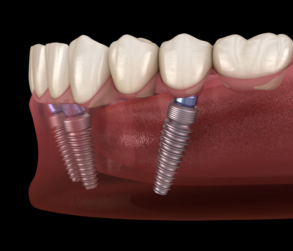all on 4 dental implants in cost belmont area