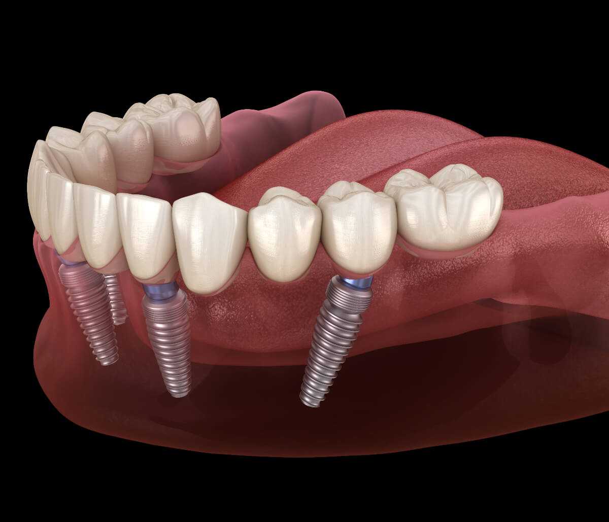 All-on-4 Dental Implants in Millbrae CA area
