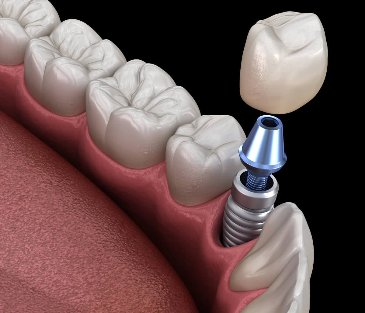 Dental implant in Foster City area