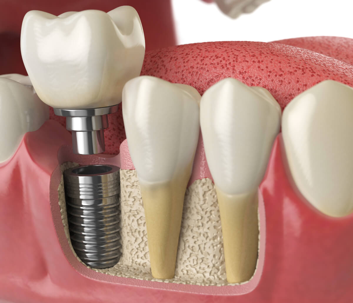 Single-Tooth Implant in Burlingame CA area
