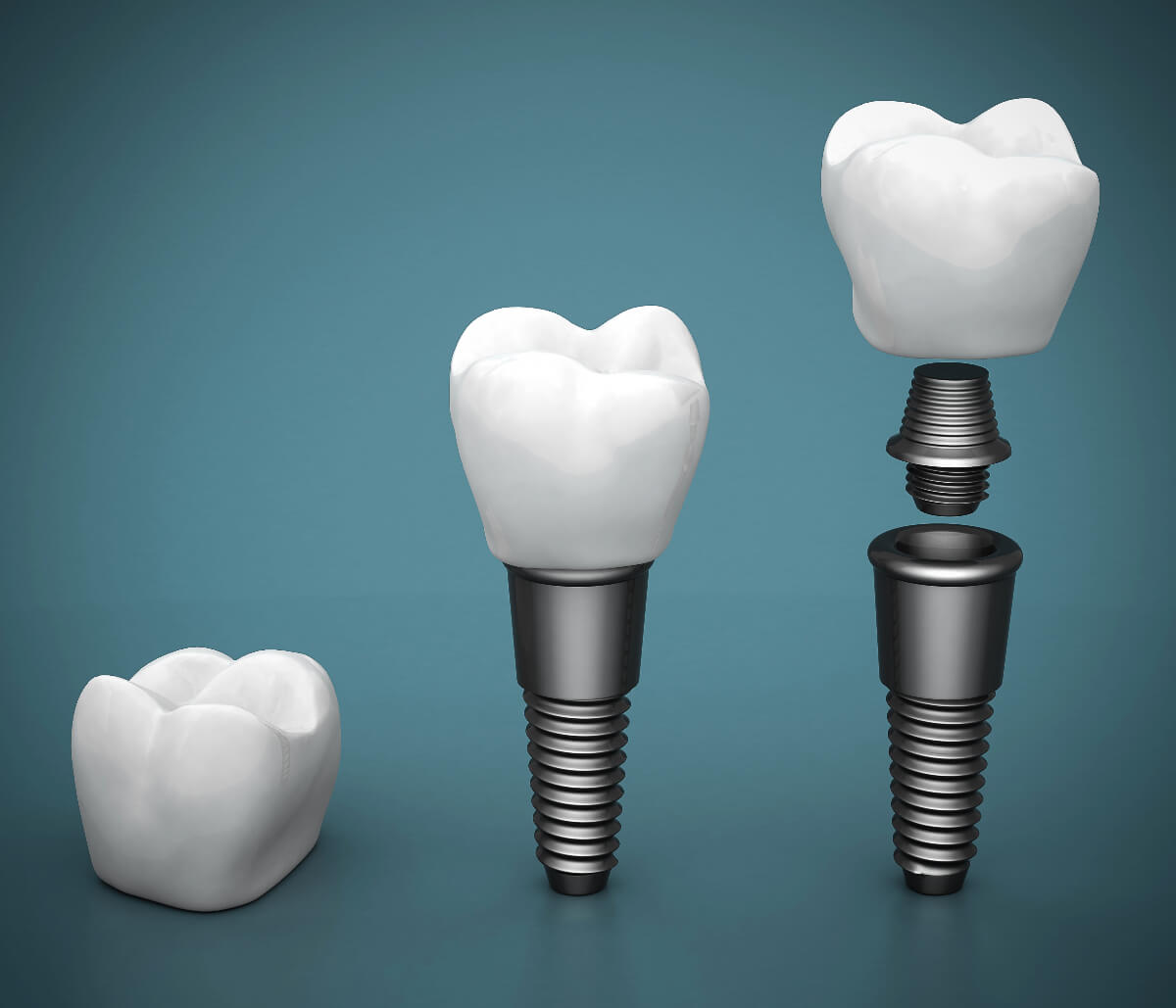 Single Tooth Implant in Daly City CA area