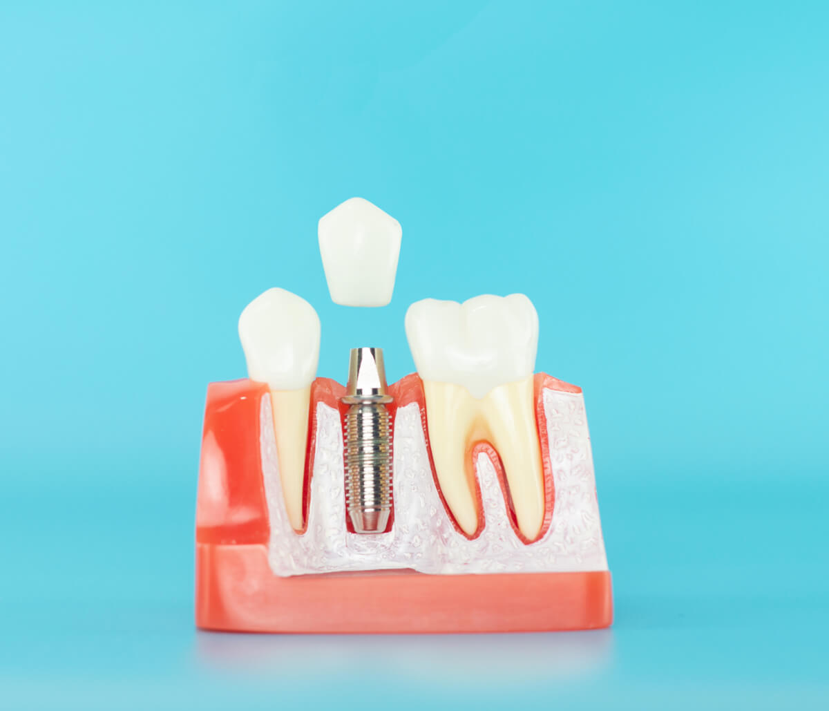 Dental Implant in Cupertino CA area