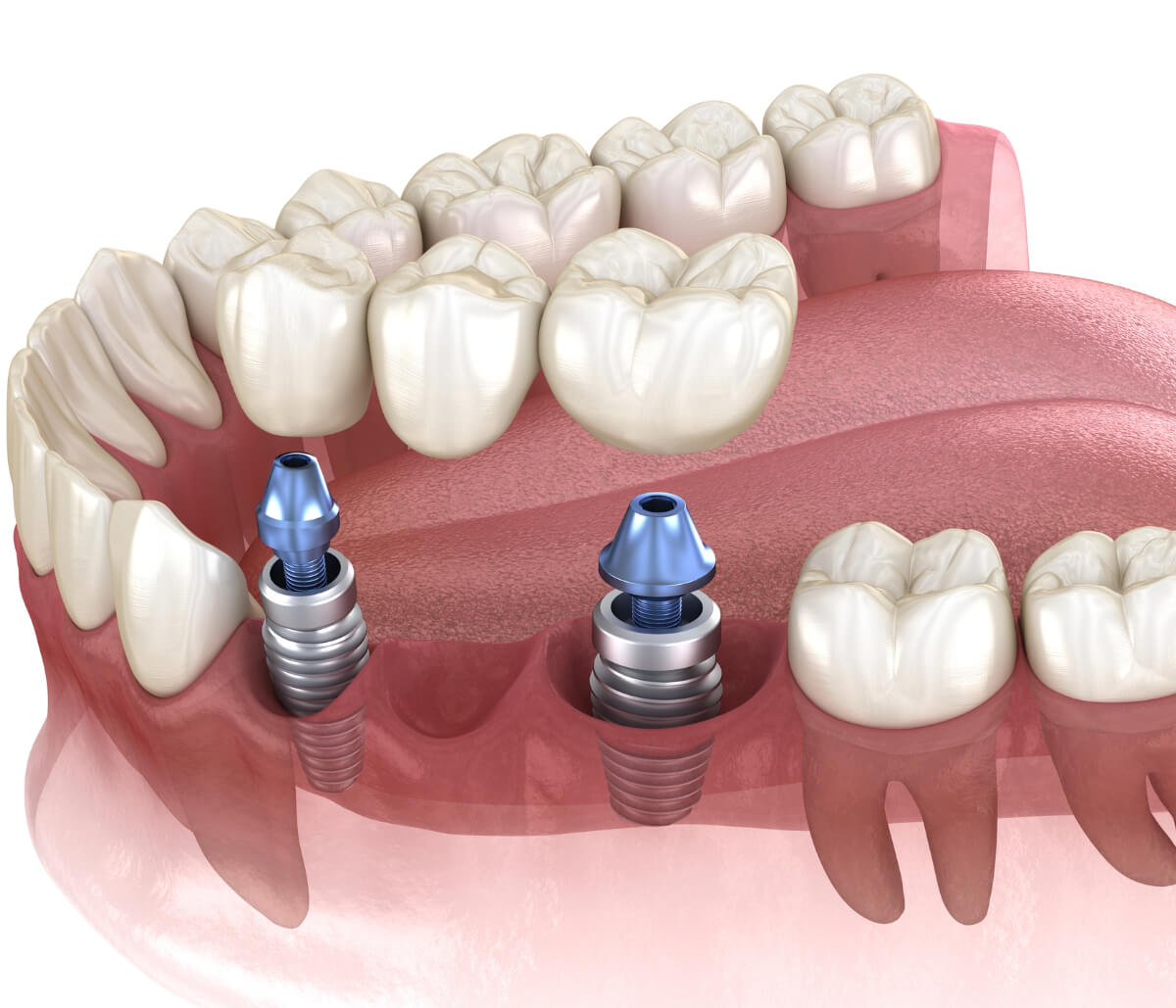 Dental Implants Crowns in Santa Clara CA area