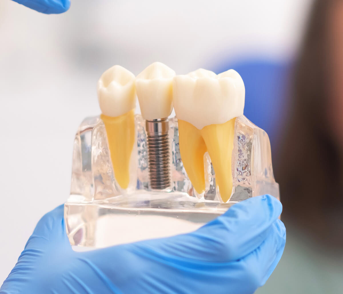 Dental Implant Specialist in San Carlos CA Area